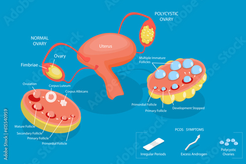 3D Isometric Flat Vector Conceptual Illustration of Polycystic Ovary Syndrome , PCOS