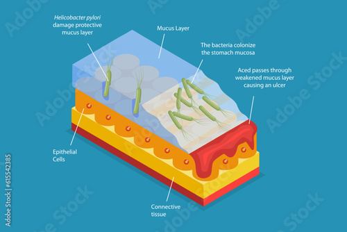 3D Isometric Flat Vector Conceptual Illustration of Peptic Ulcer, Digestive Tract Disorder