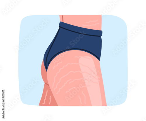 Woman with stretch marks legs concept