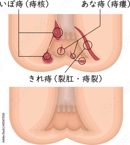 肛門 痔 イラスト