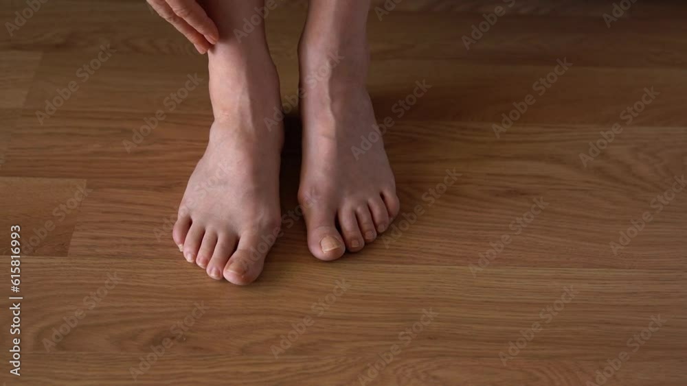 Hallux valgus on female legs on the background of laminate flooring. A bump on a woman's legs close-up. View from above. Hallux valgus on female legs on the background of laminate flooring. A bump on a woman's legs close-up. View from above.