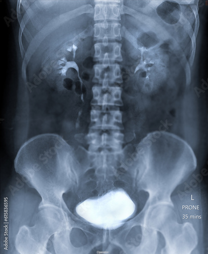  Intravenous pyelogram or I.V.P is an X-ray exam of urinary tract after injection contrast media agent  . photo
