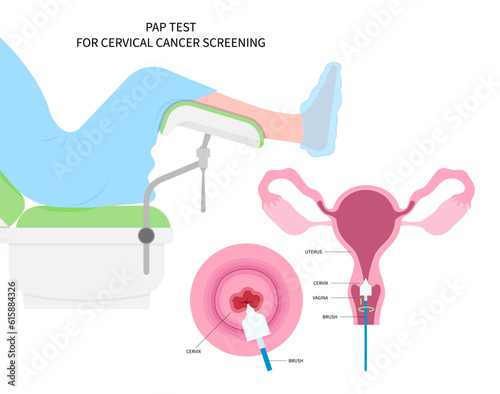 Diagnostic procedure for cervix cancer of women female and vulvar warts obstetric swab cytology by cervical pap smear test the HPV with loop excision or LEEP examine sex cell cone prevent screen care photo