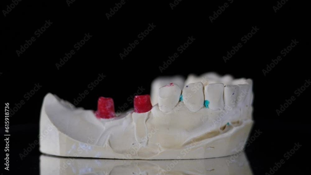 Rotating jaw model with missing teeth in need of dental crown or veneer