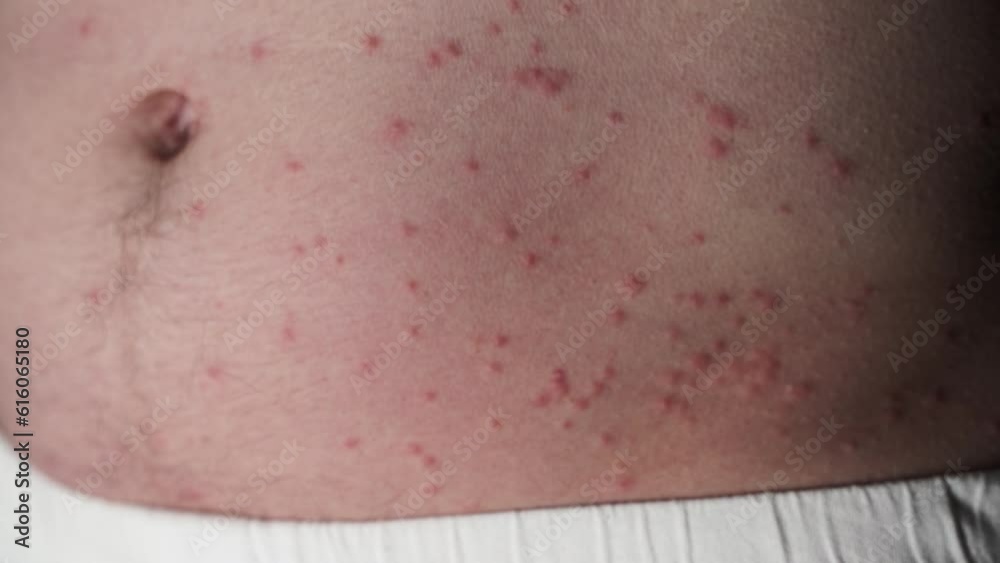 Summertime Rashes - Pimples on the body, stomach. Possible insect bites, allergic reaction. Severe itching. Closeup of man's belly. Summertime Rashes - Pimples on the body, stomach. Possible insect bites, allergic reaction. Severe itching. Closeup of man's belly.