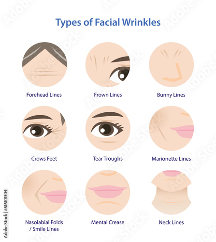 Types of facial wrinkles vector icon set. Icon set of Forehead, Bunny, Marionette, Frown lines, Mental crease, Crows feet, Tear troughs, Nasolabial folds, Smile and Neck lines.