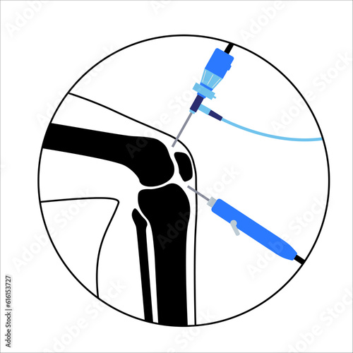 Knee joint arthroscopy