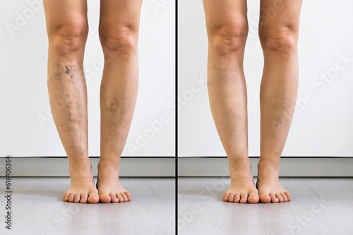 Photos Person Leg With Varicose Veins And Capillaries Before