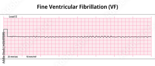 ECG Fine Ventricular Fibrillation - 8 Second ECG Paper - Electrocardiography Medical Vector Illustration