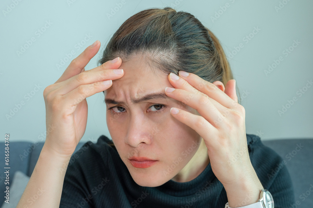 Asian woman worrying about her forehead with part of her thin hair, she had hair loss problem. Asian woman worrying about her forehead with part of her thin hair, she had hair loss problem.