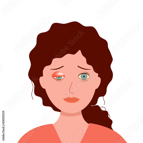 Woman with swollen eye in flat design on white background.