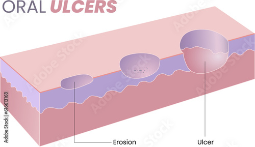 illustration of oral ulcer diagram photo