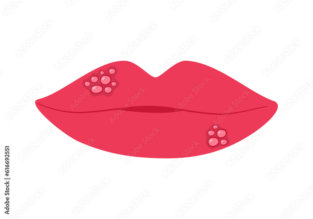 Herpes on female lips in flat design on white background.