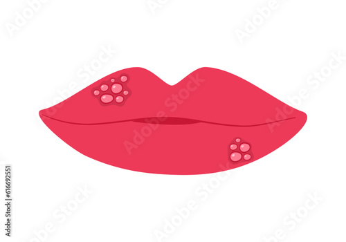 Herpes on female lips in flat design on white background.