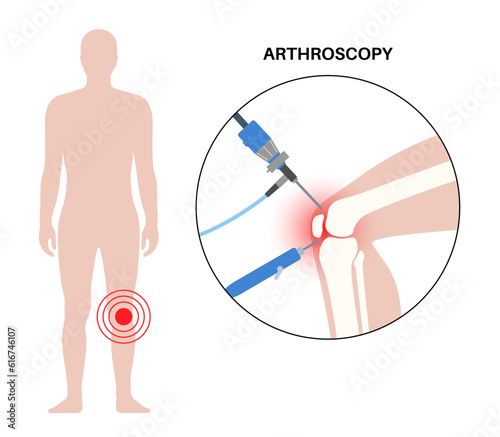 Knee joint arthroscopy