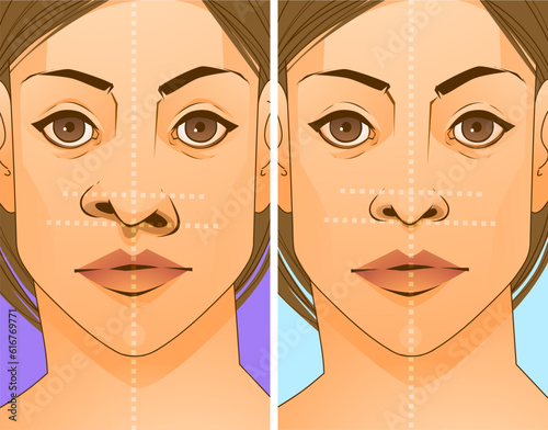 Rhinoplasty, before and after. Correction the shape of the human's nose. Medical illustration. Vector illustration.