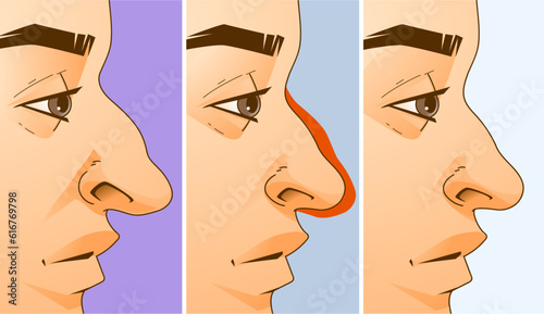 Rhinoplasty, before and after. Correction the shape of the human's nose. Medical illustration. Vector illustration.