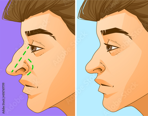 Rhinoplasty, before and after. Correction the shape of the human's nose. Medical illustration. Vector illustration.
