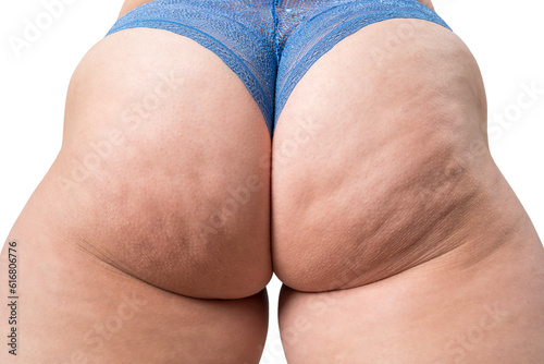 Overweight thigh, woman with fat hips and buttocks, obesity female body with cellulite