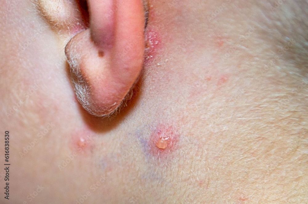 Fototapeta premium Varicella virus or Chickenpox bubble rash on child