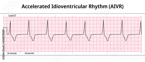 ECG Accelerated Idioventricular Rhythm - 8 Second ECG Paper - Electrocardiography Medical Vector Illustration