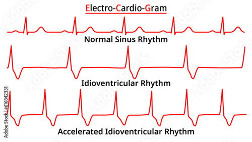Set of ECG Common Abnormalities - Idioventricular Rhythm vs Accelerated (AIVR) - Normal Sinus Rhythm - Electrocardiography Vector Medical Illustration photo