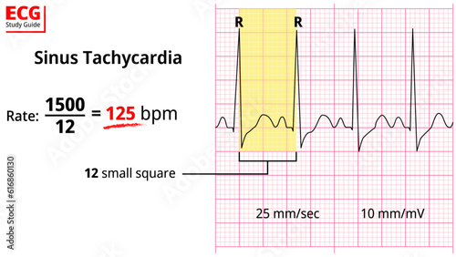 Sinus Tachycardia - ECG Education with Study Guide - Medical Vectors Illustrations