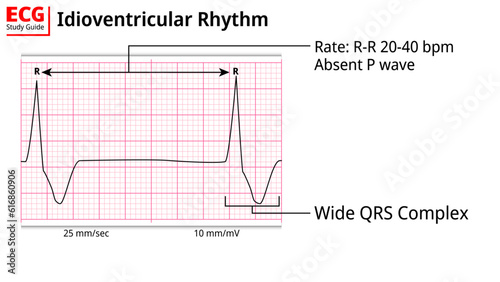ECG Idioventricular Rhythm - ECG Education with Study Guide - Electrocardiogram Medical Vectors Illustrations