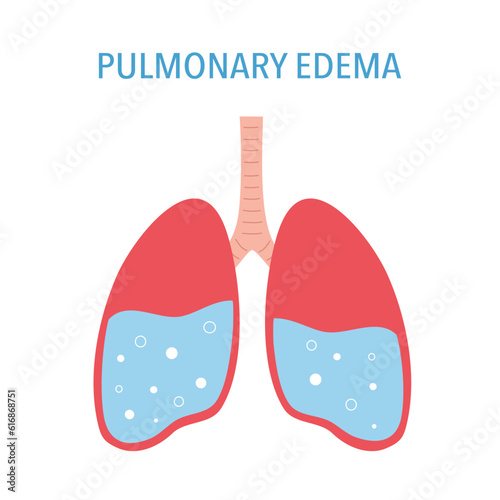 Pulmonary edema lung disease concept vector illustration on white background.