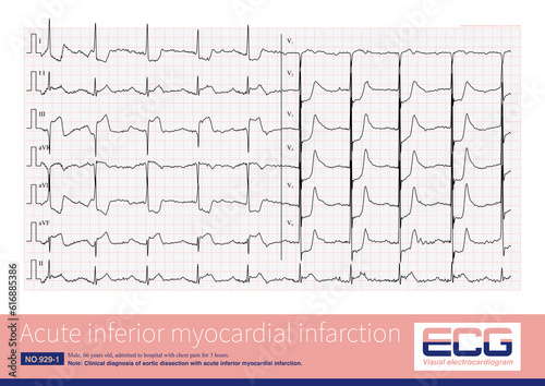Obraz na płótnie Male, 66 years old, admitted to hospital with chest pain for 3 hours