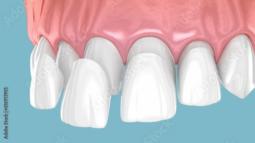 Dental veneer placement over central and lateral incisor. 3D animation
