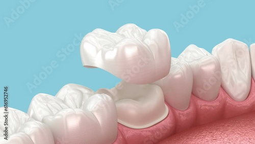 Preparated molar tooth and dental crown placement. Dental 3D animation