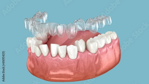 Invisalign braces or invisible retainer make bite correction. Medically accurate 3D animation