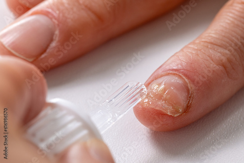 fungal nail infection treatment. applying amorolfine antifungal lacquer on hand fingernail photo