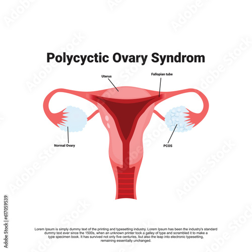 Polycystic ovary syndrome vector illustration