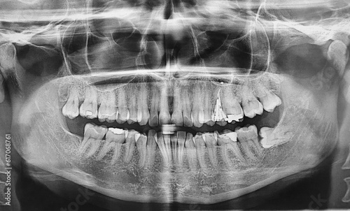 dental x-ray with impacted wisdom tooth
