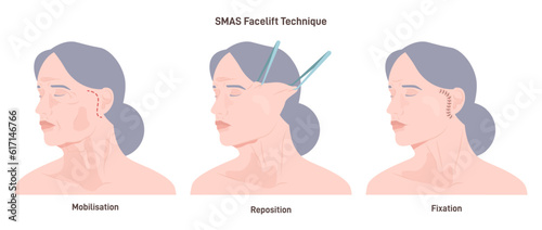 SMAS facelift surgery. Face features correction or anti-aging procedure photo