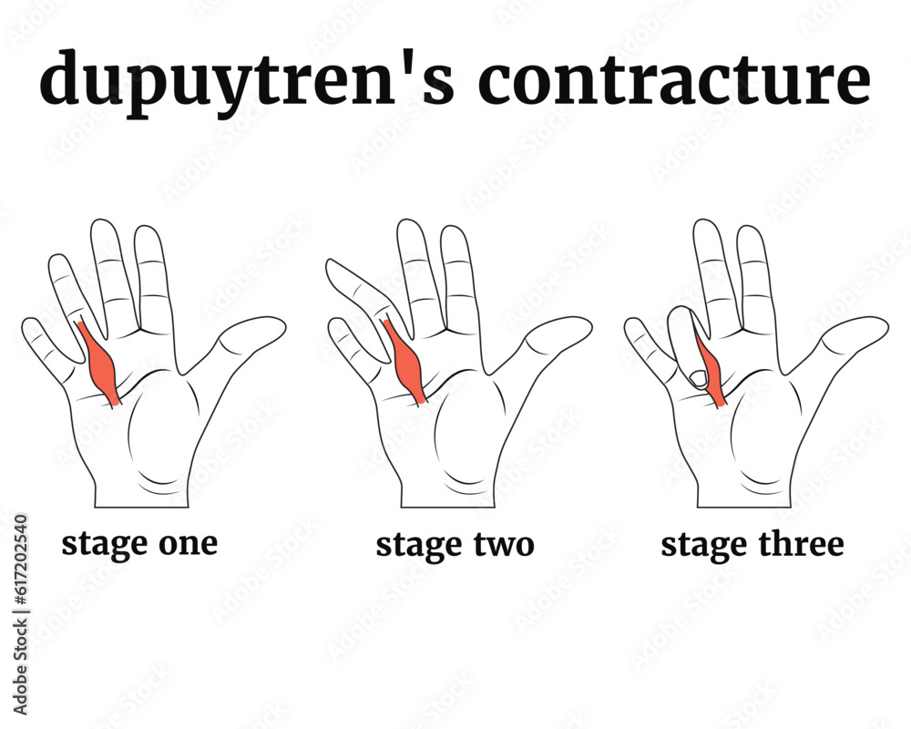 Jupuytren contracture. Black and white infographic with disease stages