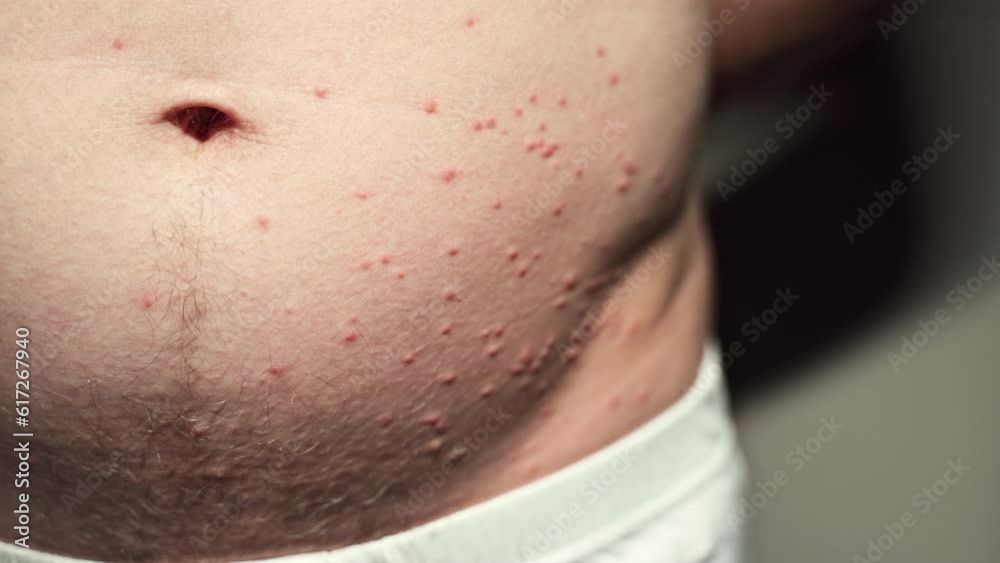Pimples on the body, stomach. Possible insect bites, allergic reaction. Severe itching. Closeup of man's belly. Pimples on the body, stomach. Possible insect bites, allergic reaction. Severe itching. Closeup of man's belly.