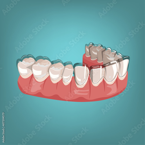 Orthodontic silicone trainer. Medical drawing in cartoon style.