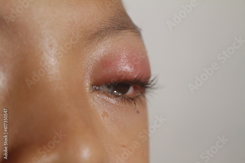 swollen eye pain in children
 photo