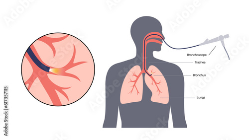 Bronchoscopy procedure concept