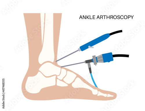 Ankle arthroscopy poster