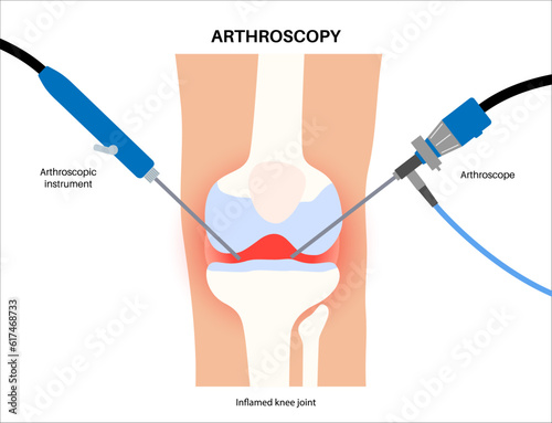 Knee joint arthroscopy