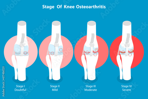 3D Isometric Flat Vector Conceptual Illustration of Stage Of Knee Osteoarthritis, Anatomy of Leg Joints