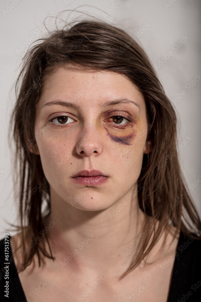 black-and-blue eye of a woman victim of domestic violence and abuse black-and-blue eye of a woman victim of domestic violence and abuse
