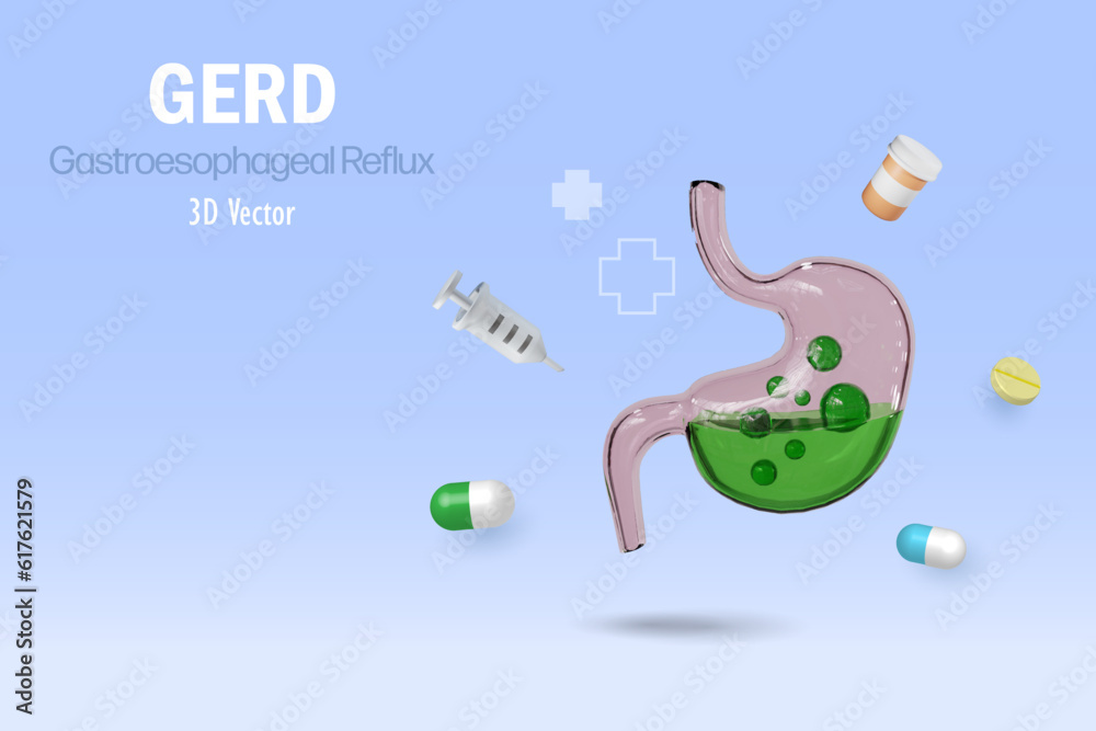 GERD gastroesophageal reflux acid on stomach. Digestive disorder causes patient heartburn pain or acid reflux indigestion. Medical and healthcare. 3D vector. GERD gastroesophageal reflux acid on stomach. Digestive disorder causes patient heartburn pain or acid reflux indigestion. Medical and healthcare. 3D vector.