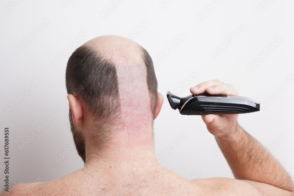 Hair Loss Solutions: Shaving Head Safely After Thinning Hair