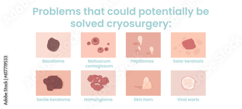 Cryosurgery is used to treat benign and malignant skin tumors. Skin problems that can potentially solve cryosurgery. Flat vector illustration.
