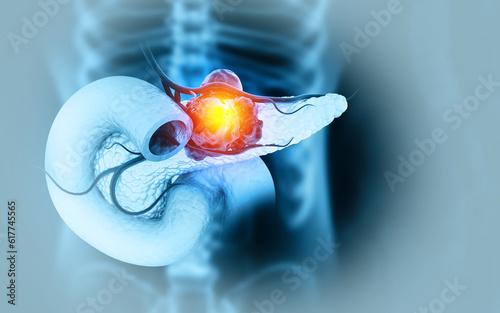 Pancreatic cancer is cancer that forms in the cells of the pancreas. 3d illustration photo